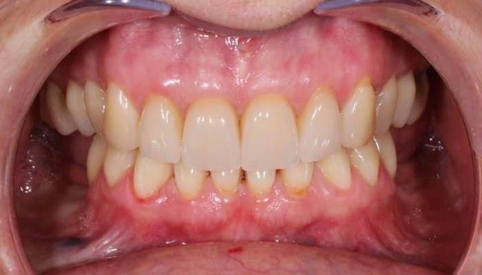 Направленная костная регенарация и последующая мягкотканная пластика в боковых отделах нижней челюсти