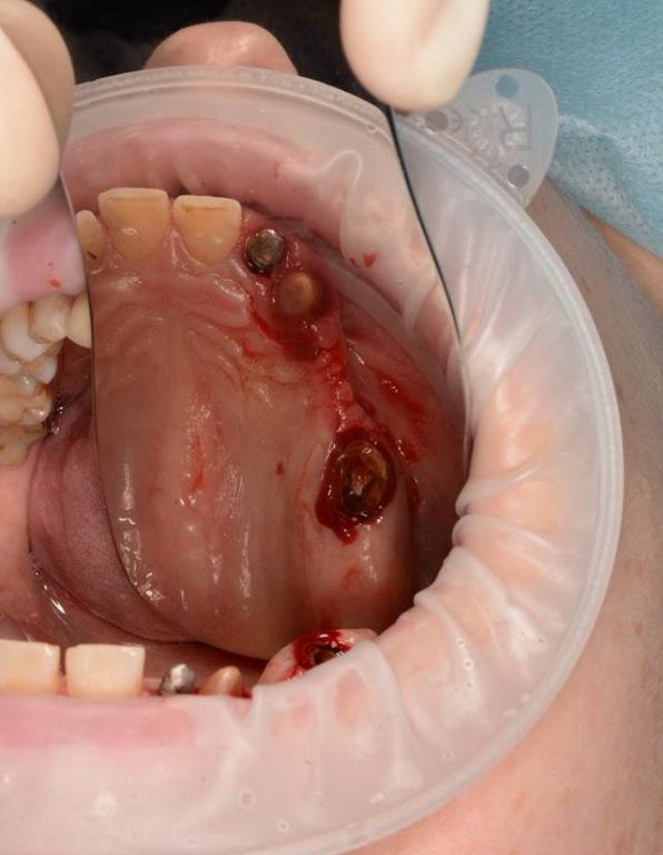 Операция удаления зуба 1.3 и 1.7. НКР сегмента I по методике Ф.Кюри.