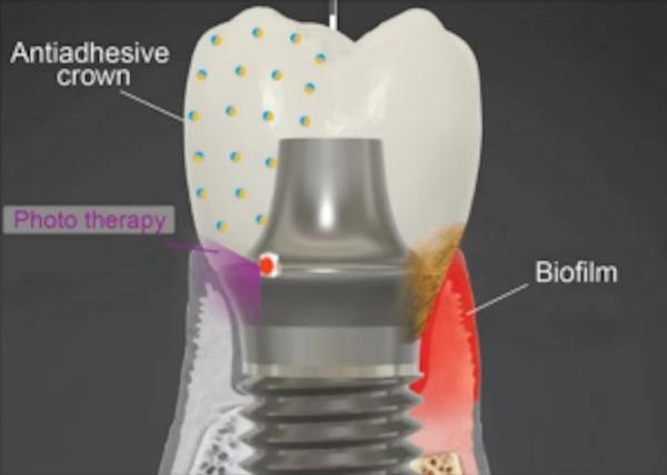 Исследователь-стоматолог из Пенсильвании получил 2,6 миллиона долларов на разработку имплантата для борьбы с микробами