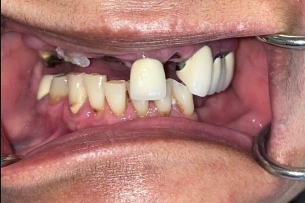 Использование аутологичной структуры зуба в качестве дополнительного метода трансплантации при восстановлении зубной дуги дентальными имплантатами