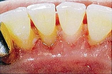 зубные отложения