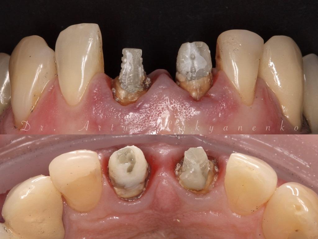Лечение зубов после снятия коронок