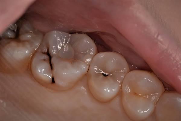 Реставрация зубов 2.5, 2.6 и 2.7