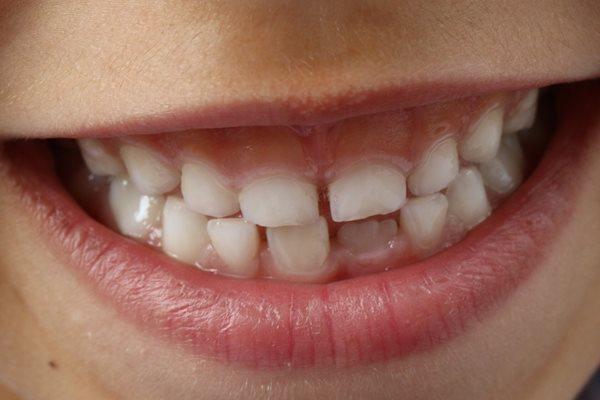 Молочные зубы однажды смогут помочь выявить детей, подверженных риску психических расстройств в более позднем возрасте