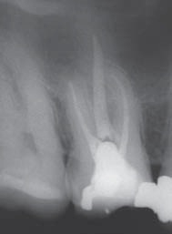 При лечении зуба в канале оставлен инструмент
