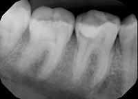 Лечение зуба без прокладки thumbnail