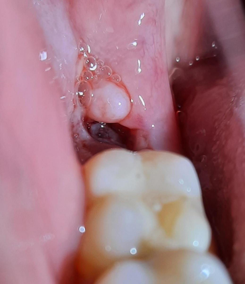 Как долго заживает лунка после удаления зуба?