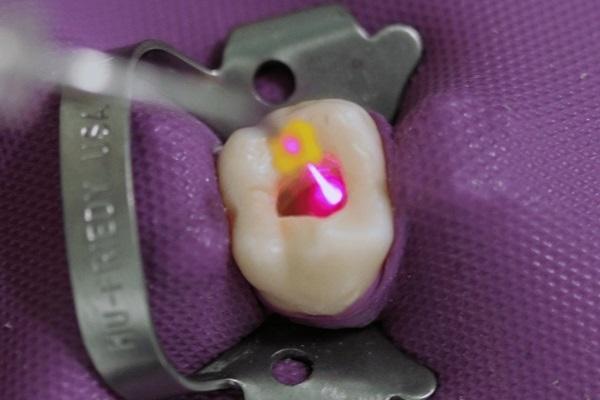 Лазерная ирригация при эндодонтическом лечении зуба с обтурацией корневых каналов