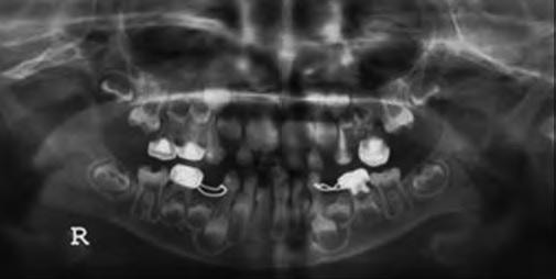 Фото 4: Панорамная рентгенограмма. У первых постоянных моляров наблюдается гипоплазия эмали и дентина.