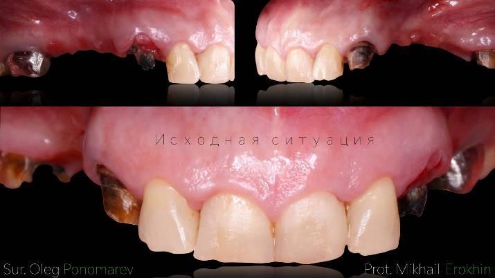 Восстановление верхнего зубного ряда с опорой на зубы и имплантаты
