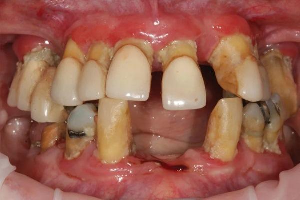 Комбинирование цифровых технологий и традиционных принципов для оптимизации изготовления полных съемных зубных протезов