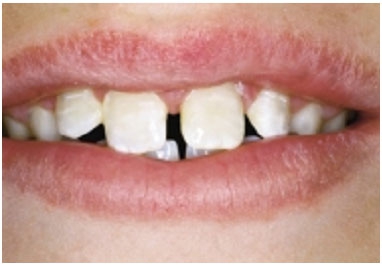 Лечение скола молочного зуба