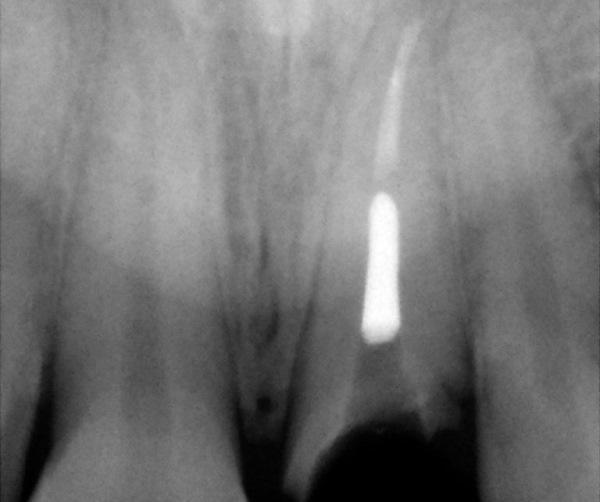 Немедленная имплантация в позиции зуба 21