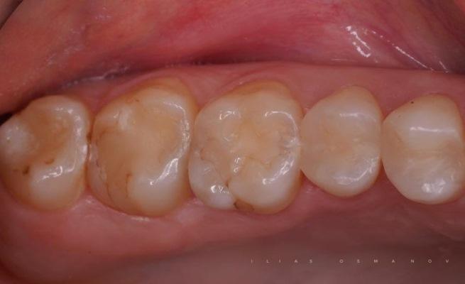 Прямая реставрация зубов 26, 27