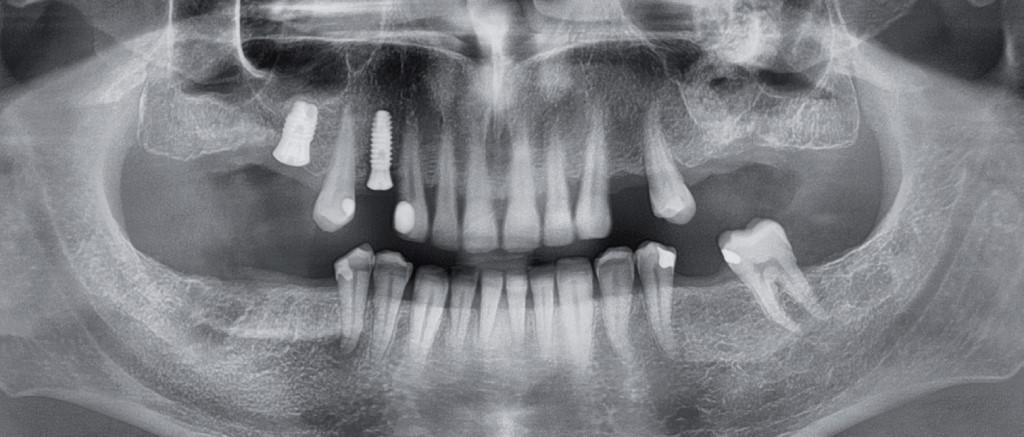 Эмфизема лица при лечении зубов