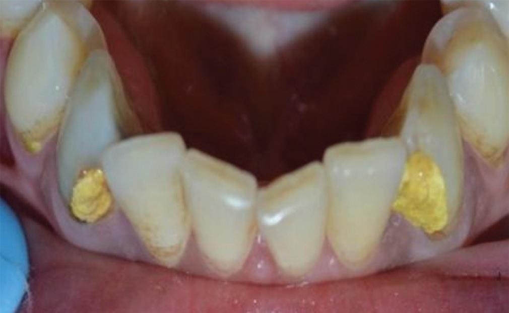 Жидкость ЭДТА 20% для выявления устья и расширения корневых каналов зубов 100мл.