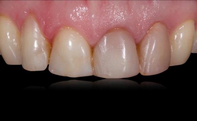 Восстановление центральных зубов с использованием коронок и виниров E.max