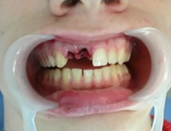 Устойчивость к перелому незрелых зубов, запломбированных MTA или цементами, обогащенными кальцием