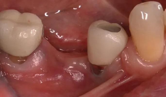 Увеличение объема альвеолярного гребня в месте предыдущей неудачной попытки имплантации при помощи фиксирующих винтов в комбинации с аллотрансплантатом и коллагеновой мембраной