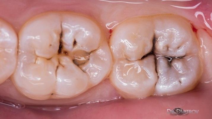 Кариес дентина зуба 4.7