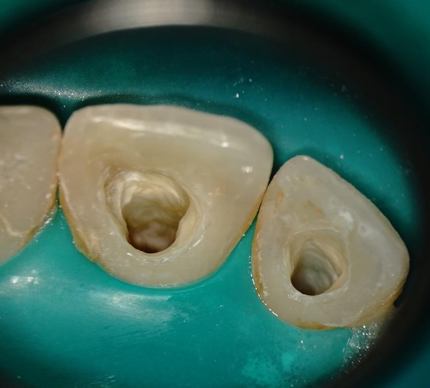 При лечении зуба положили кальций