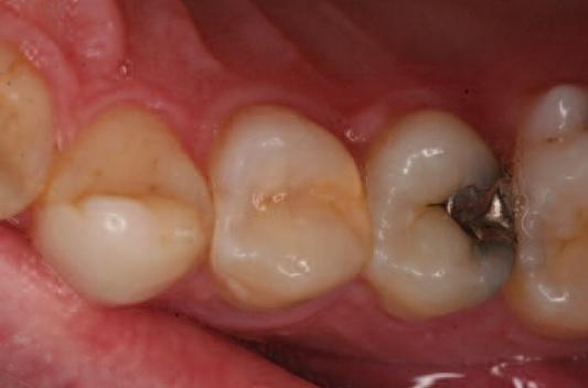 Восстановление тканей зубов при лечении кариеса thumbnail