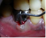 Вертикальный перелом зуба диагностика thumbnail