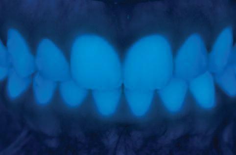 Почему светятся зубы при ультрафиолете