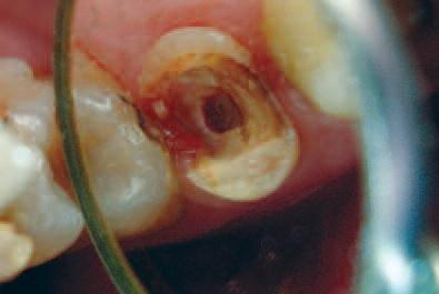 Повторное эндодонтическое лечение и адгезивная реставрация второго премоляра при утрате существенного объема структуры зуба