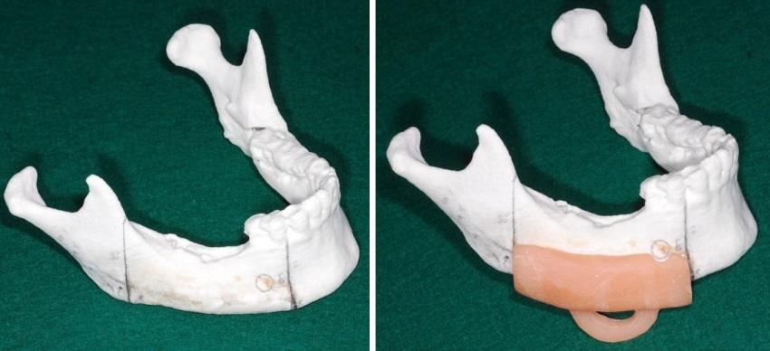 Оптимизированная техника репозиции нижней челюсти с помощью хирургического шаблона после сегментарной мандибулэктомии