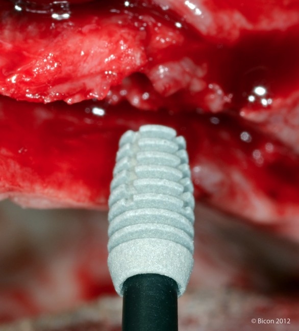 В костную лунку устанавливается 4,5 х 6,0 мм имплант Bicon Integra-Ti с 2,5 мм каналом.