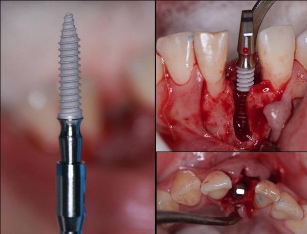 Одномоментная имплантация с немедленной нагрузкой в переднем отделе нижней челюсти с использованием однокомпонентных имплантатов узкого диаметра