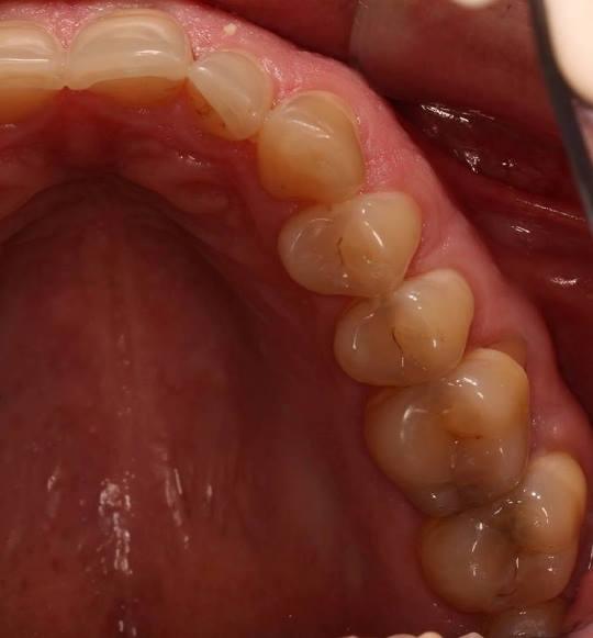 Построение контактов у боковых зубов