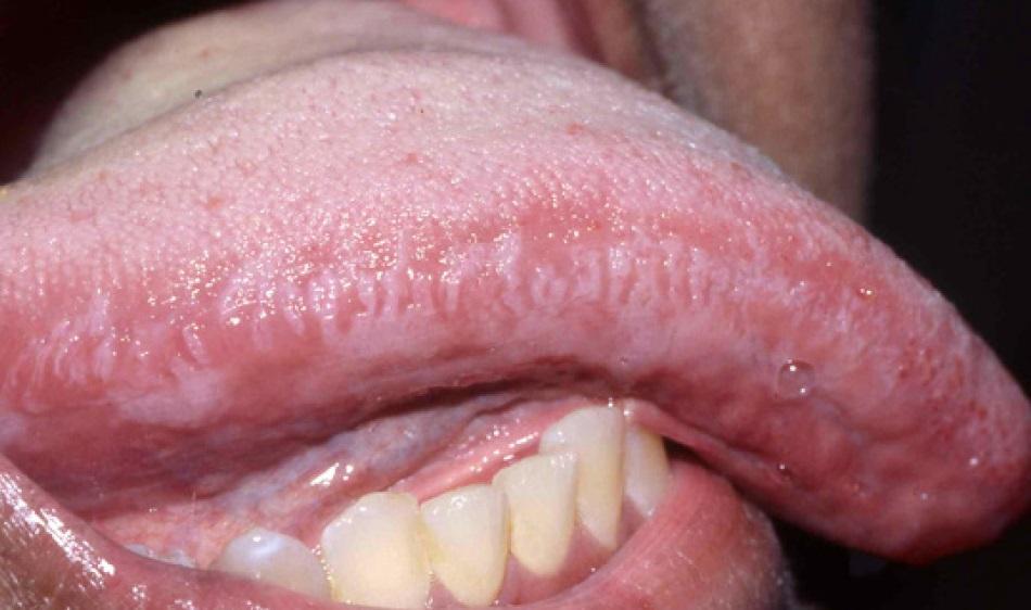 Проявления ВИЧ в полости рта