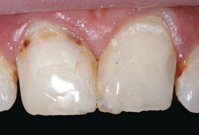 Метод лечение фронтальных зубов thumbnail