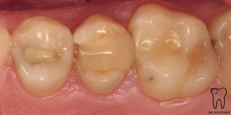 Лечение кариеса и восстановление зуба после лечения корневых каналов