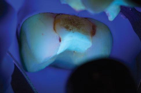 Ультрафиолет при лечении зубов