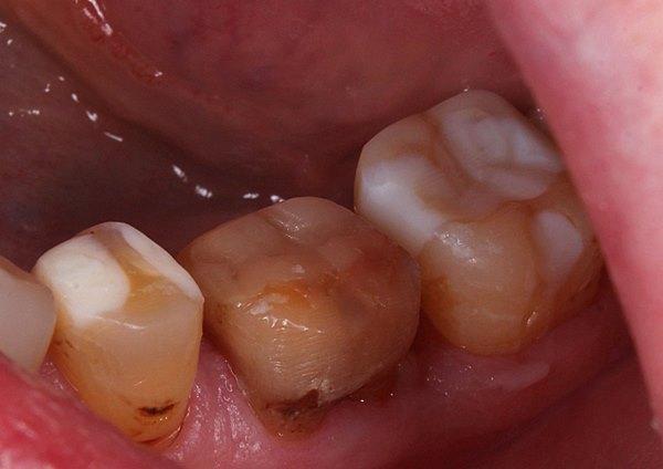 Протезирование жевательной группы зубов (компромиссный вариант)