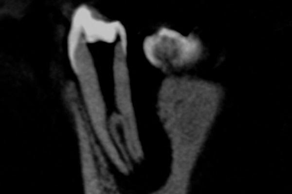 Важность конусно-лучевой компьютерной томографии при эндодонтическом лечении премоляра нижней челюсти с атипичной анатомией