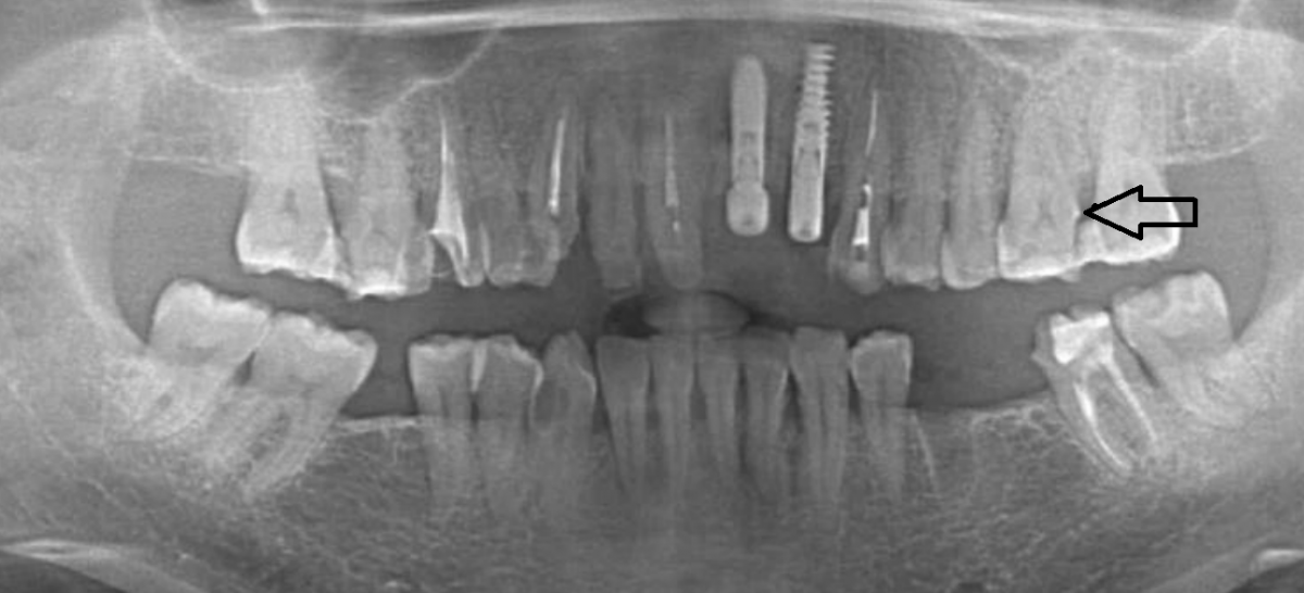 Снимок зубов видное. Ортопантомография пульпит. Пульпит рентген под пломбой. Пульпит корня зуба рентген.