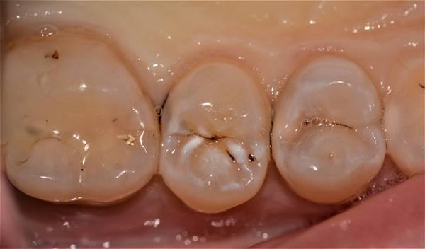 Реставрация зуба 1.5 с дистальным поддесневым поражением
