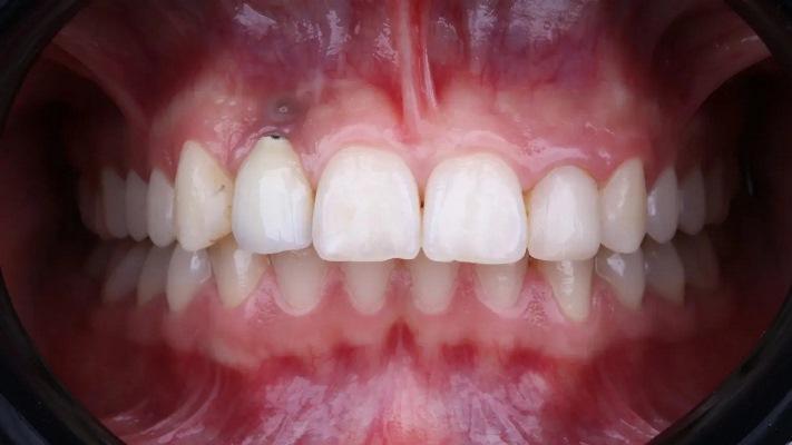 Эффективные стратегии лечения позднего отказа имплантата и периимплантита