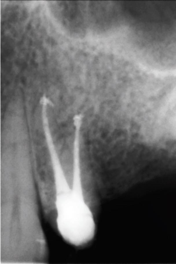 Хлор при лечении зуба thumbnail