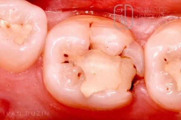 Художественная реставрация зуба 3.6 (пошаговый протокол)