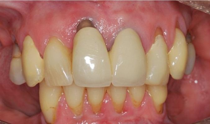 Метод цифрового программирования для упрощения процесса последовательного удаления зубов и последующей имплантации