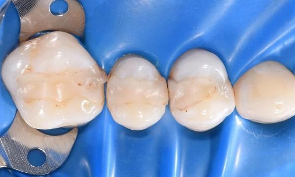 Лечение кариеса зубов D1.6;1.5;1.4 прямым методом с применением современных композитных материалов