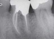 Перелом инструмента в корневом канале зуба