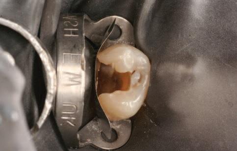 Реставрация зуба при глубоком кариесе