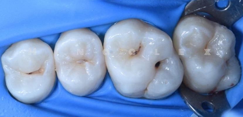 Реставрация жевательных зубов с применением методики штампа