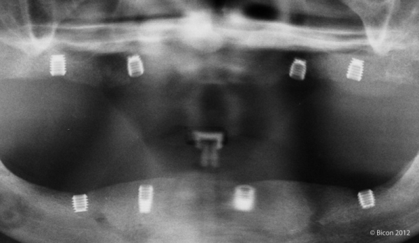 Третий визит через три месяца после установки одного верхнечелюстного 5,0 х 6,0 мм и трёх 4,5 х 6,0 мм имплантов. Рентгенограмма перед раскрытием имплантов.